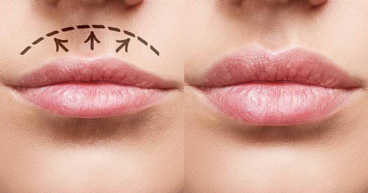 Lip Lift (podizanje gornje usne)