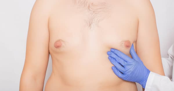 Ginekomastija i smanjenje muških grudi