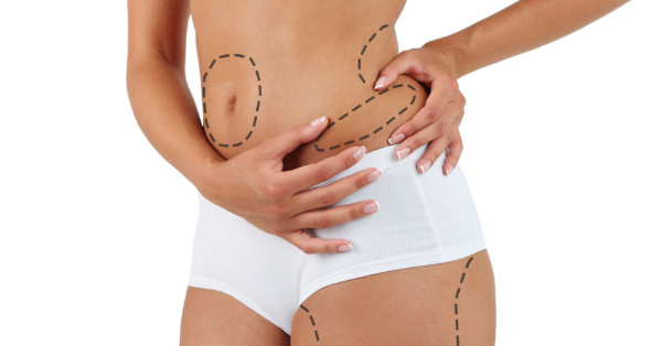 Liposuction